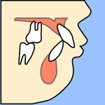 上顎前突（じょうがくぜんとつ）