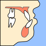 下顎前突（かがくぜんとつ）