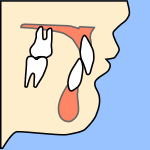 過蓋咬合（かがいこうごう）