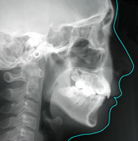 側貌頭部X線規格写真