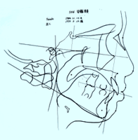 側貌頭部X線規格写真のトレース
