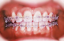 マルチブラケット（正面）