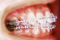 マルチブラケット（横顔）