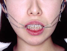 Jフック・ヘッドギア（正面）